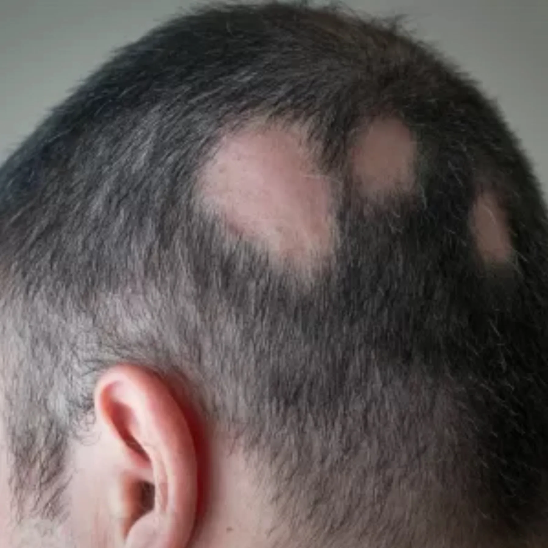Acompanhamento capilar para alopecia areata
