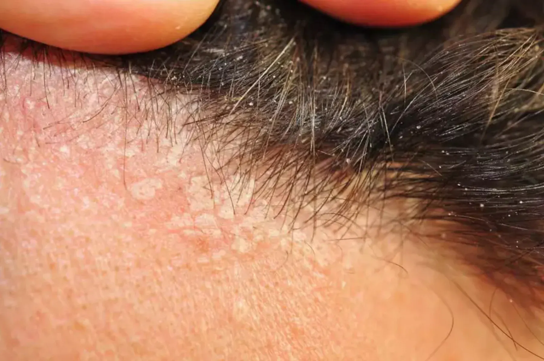 Dermatite seborreica — couro cabeludo antes do tratamento